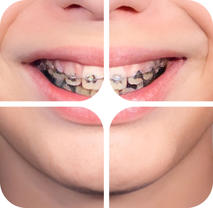 Preventive dental fillings for children
