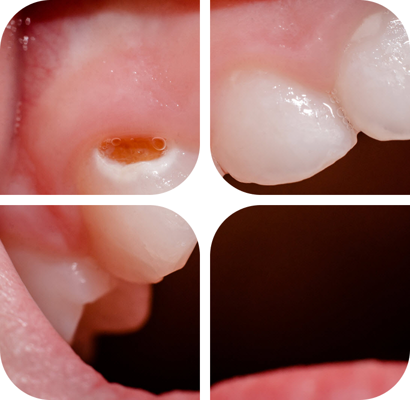 Children dental prevention