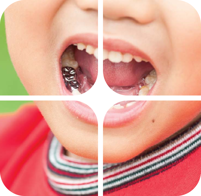 Pulp treatment and crowns for children