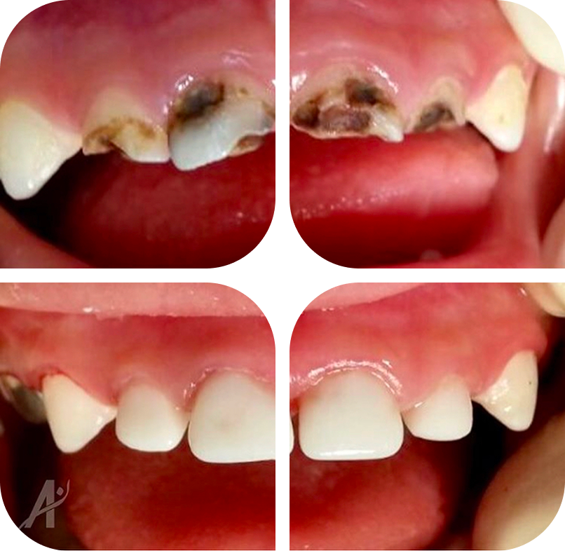 Therapeutic cosmetic fillings