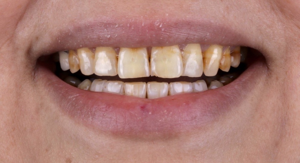 Invisalign before