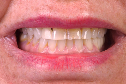 Metal Braces before
