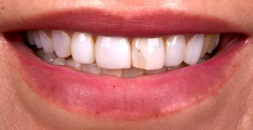 Ceramic Braces before