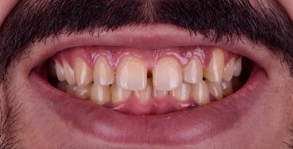 Before